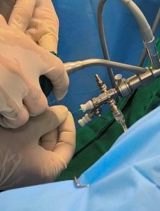 Com cirurgias de cálculos renais a laser, HRMS garante procedimentos mais modernos e seguros no SUS